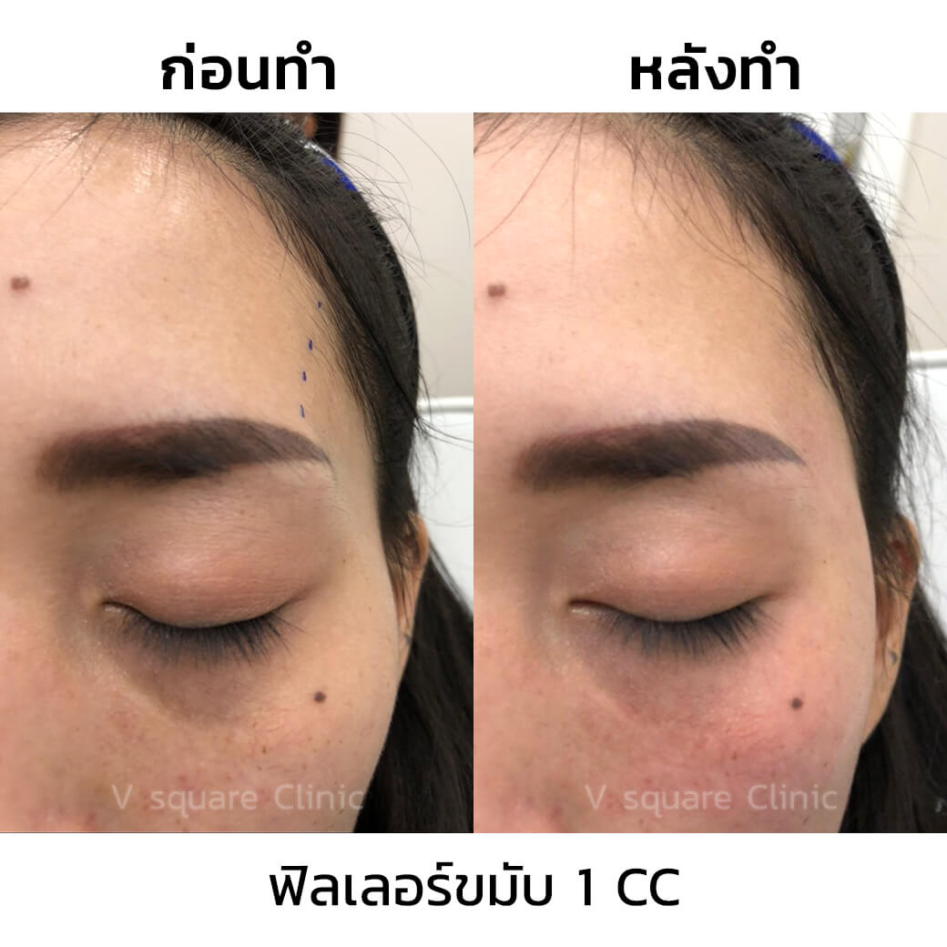 ฟิลเลอร์ขมับ-1-CC
