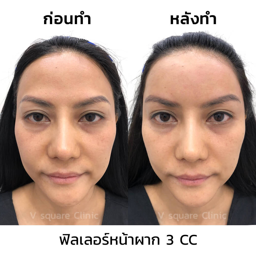รีวิวฉัดฟิลเลอร์หน้าผาก 3 CC