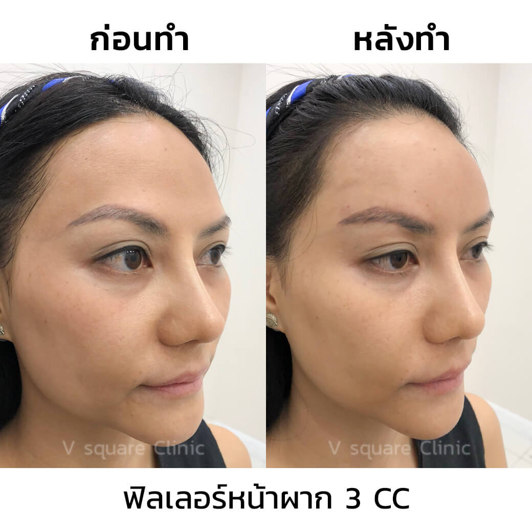 รีวิวฉัดฟิลเลอร์หน้าผาก 3 CC