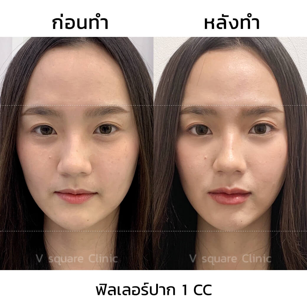 รีวิว ฉีดฟิลเลอร์ปาก 1 CC