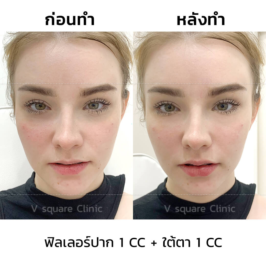 รีวิว ฟิลเลอร์ปาก 1 CC