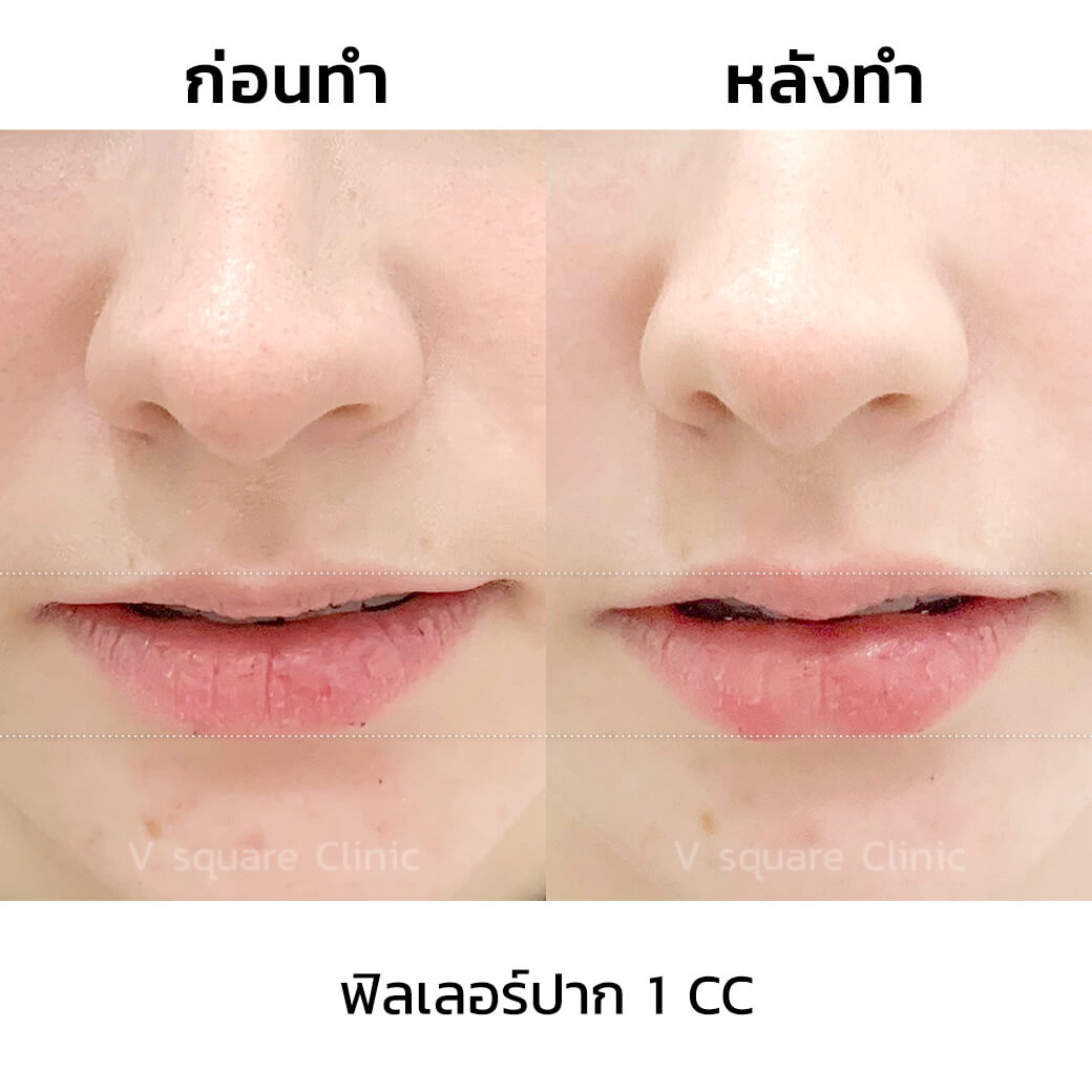 รีวิว ฟิลเลอร์ปาก ชุ่มชื้น ไม่เป็นร่อง