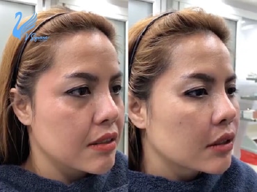 รีวิวฉีดฟิลเลอร์ร่องแก้ม