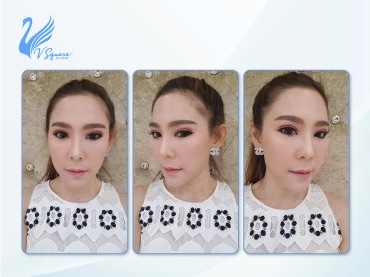 รีวิวเมโสแฟต