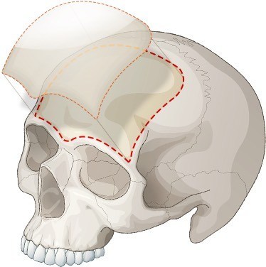 ทำไมการฉีดฟิลเลอร์หน้าผาก-ราคาสูงกว่าจุดอื่น