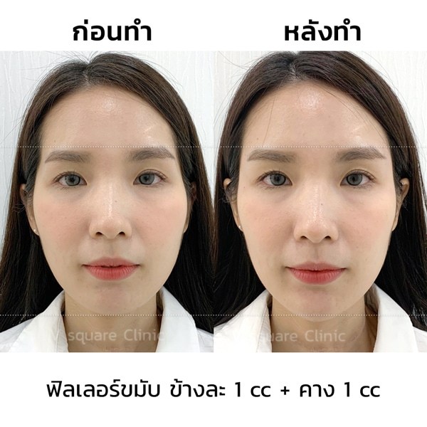 รีวิวฟิลเลอร์คาง+ขมับ