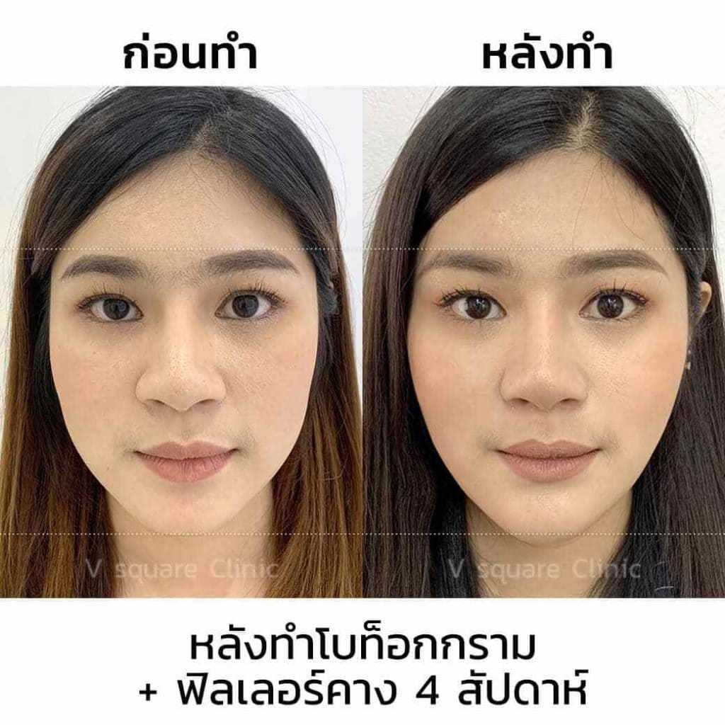 โบท็อกลดกรามหน้าเรียว-ฟิลเลอร์คาง