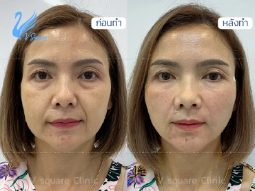 ร้อยไหม หน้าเรียว ที่ไหนดี_ ให้ปลอดภัย และเห็นผล