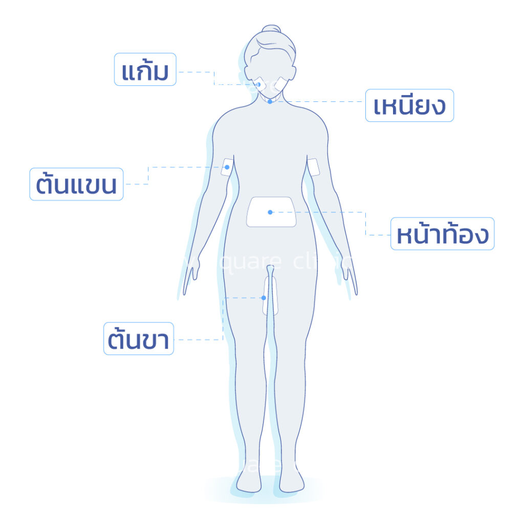 5 จุด ฉีดเมโสแฟต