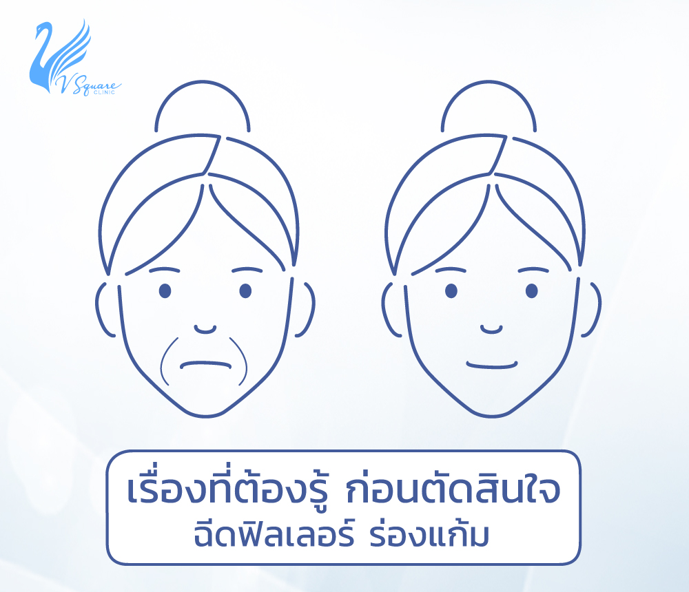 ฟิลเลอร์ร่องแก้ม