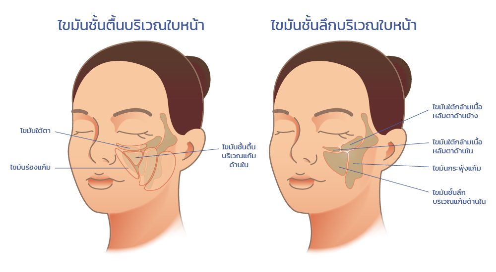 การฉีดเมโสแฟต