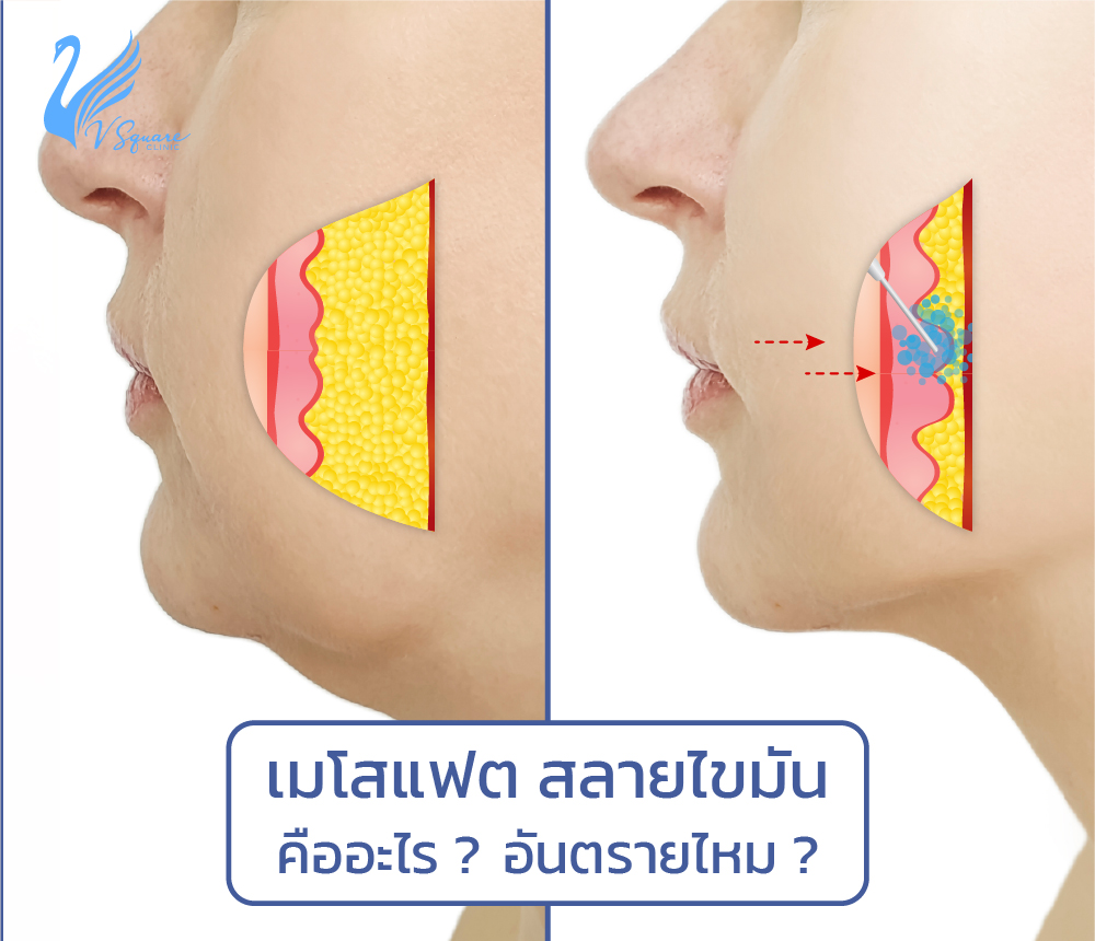 ฉีดเมโสแฟตคืออะไร