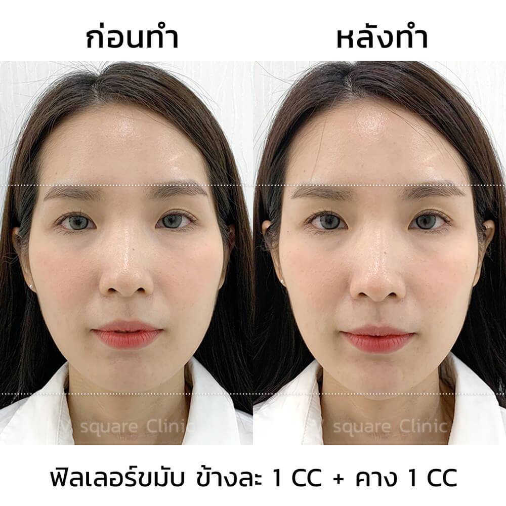 ฟิลเลอร์ขมับ-ข้างละ1ccคาง1cc