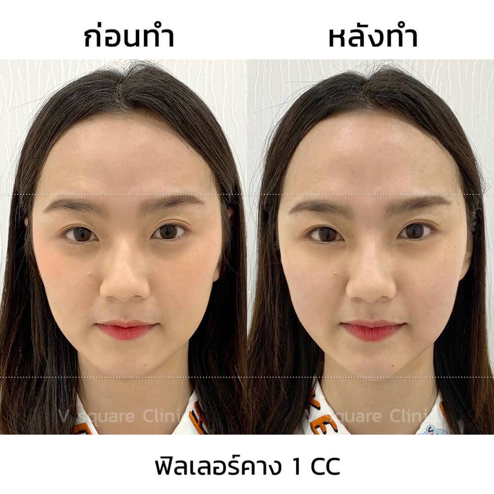 ฟิลเลอร์คาง-1-CC-1