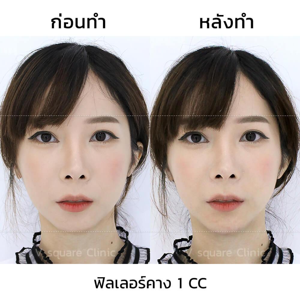 ฟิลเลอร์คาง-1-CC_ก่อนหลัง