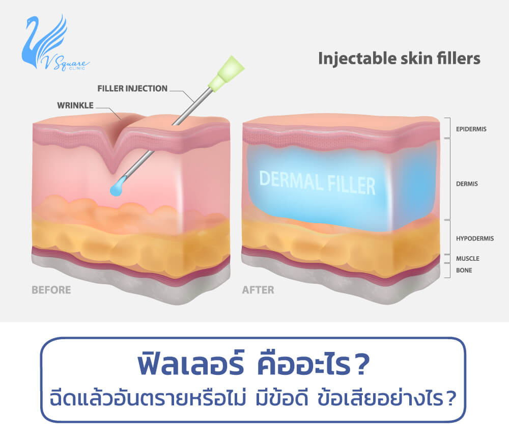 ฟิลเลอร์คืออะไร