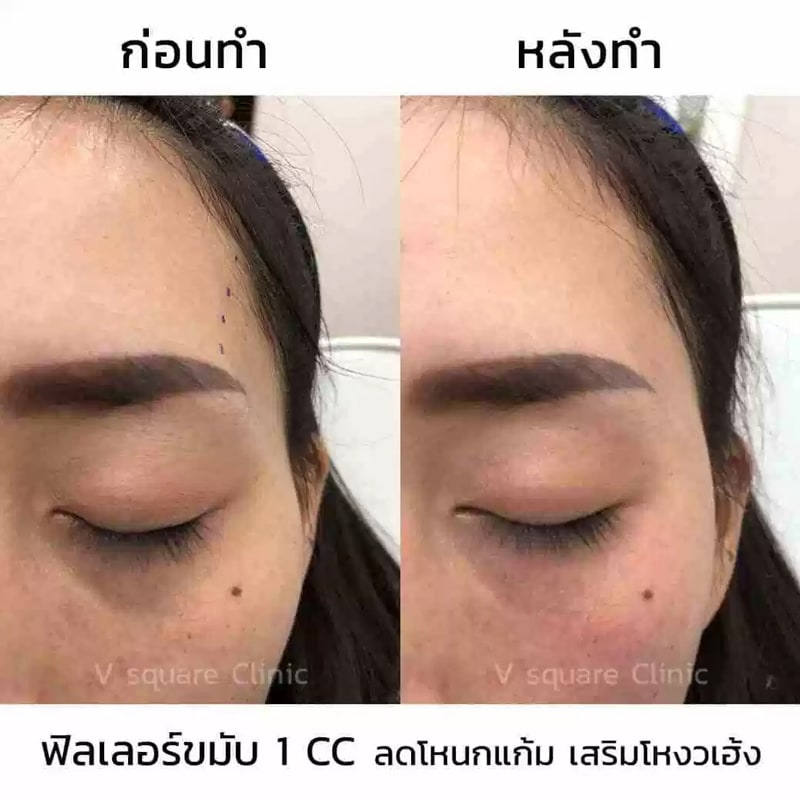 รีวิว ฉีดฟิลเลอร์ขมับ