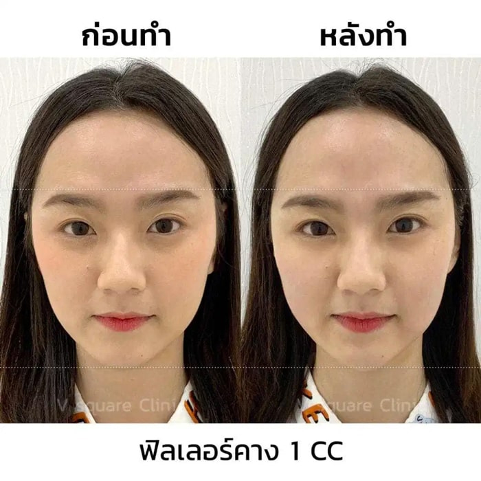 รีวิว ฟิลเลอร์คาง
