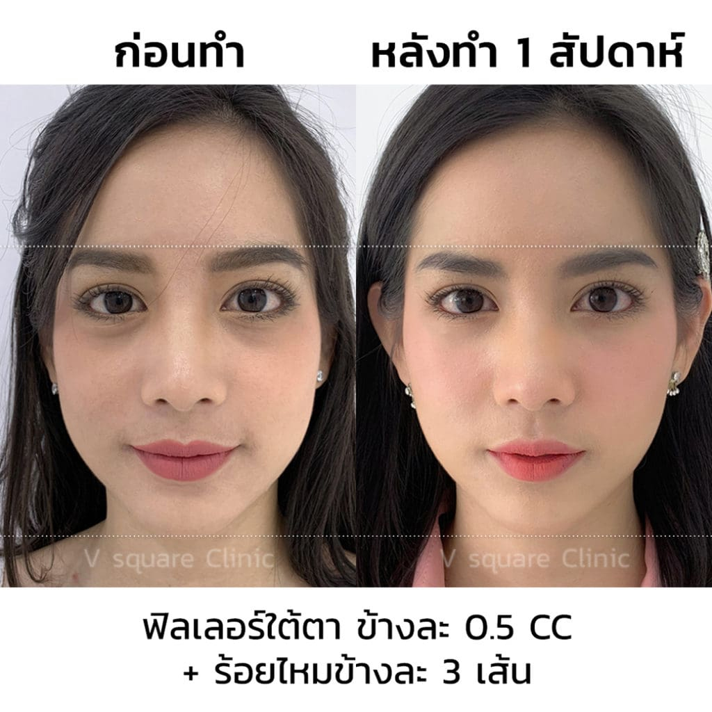 รีวิว ฟิลเลอร์ใต้ตา