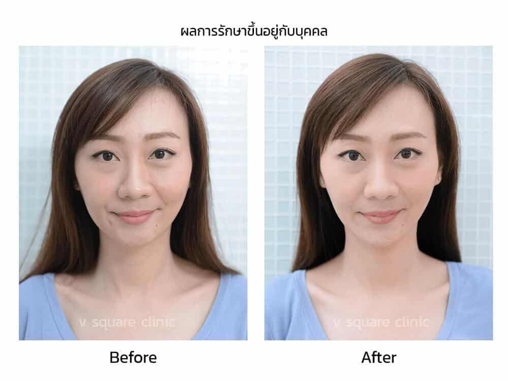 รีวิว-เติมฟิลเลอร์คาง