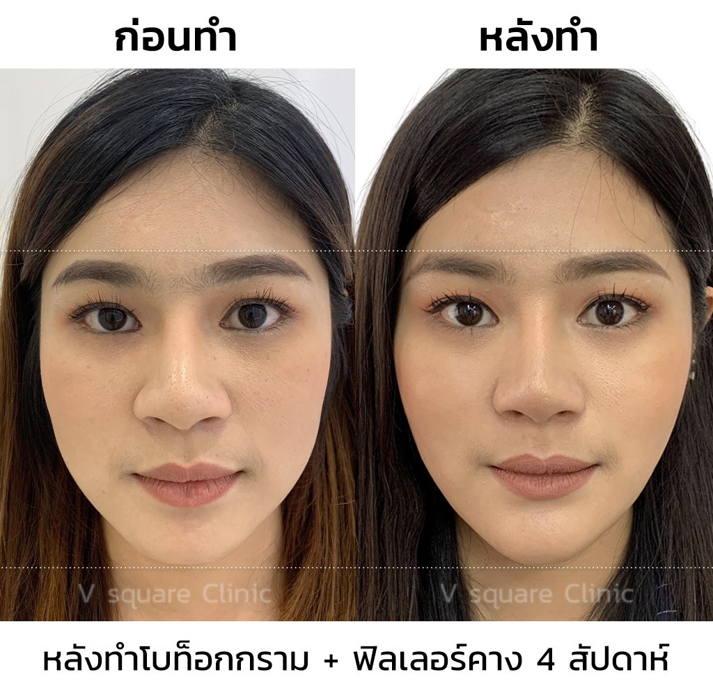 รีวิว-โบท็อกลดกราม-ปรับรูปหน้าเรียว-1