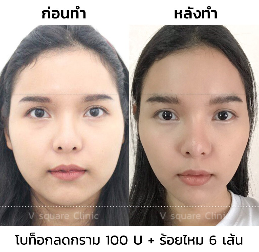 รีวิว-โบท็อกลดกราม-ร้อยไหม-ยกกระชับหน้า-ปรับรูปหน้าให้วีเชฟ