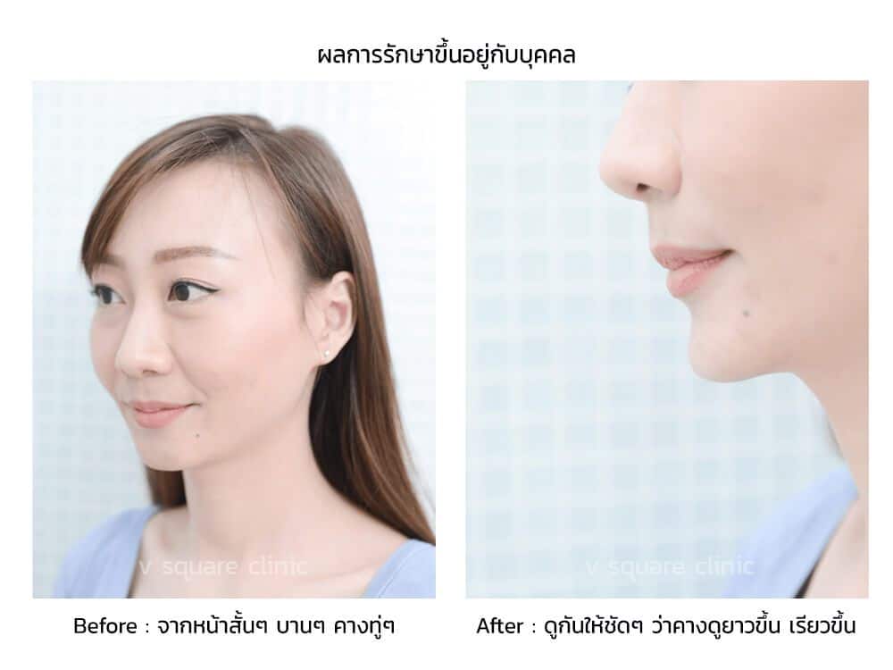รีวิวฉีดฟิลเลอร์-คาง_2
