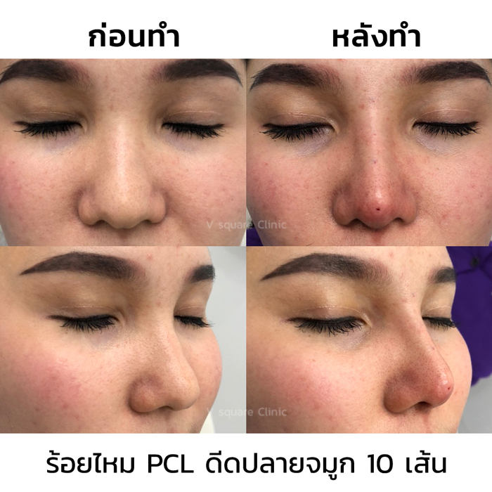 รีวิวร้อยไหมจมูก-10-เส้น
