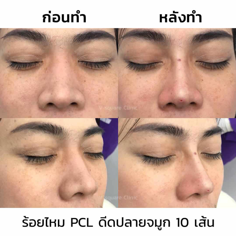 รีวิวร้อยไหมจมูก-10-เส้น