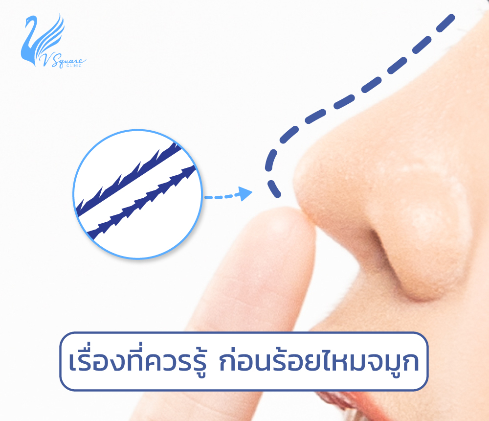 ร้อยไหมจมูก