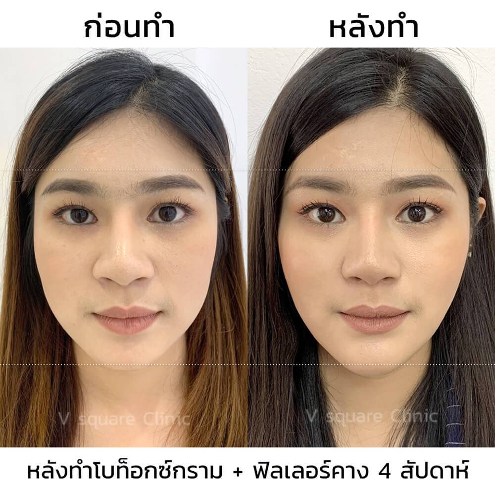 โบท็อกลดกรามและฟิลเลอร์คาง_หลังทำ4สัปดาห์