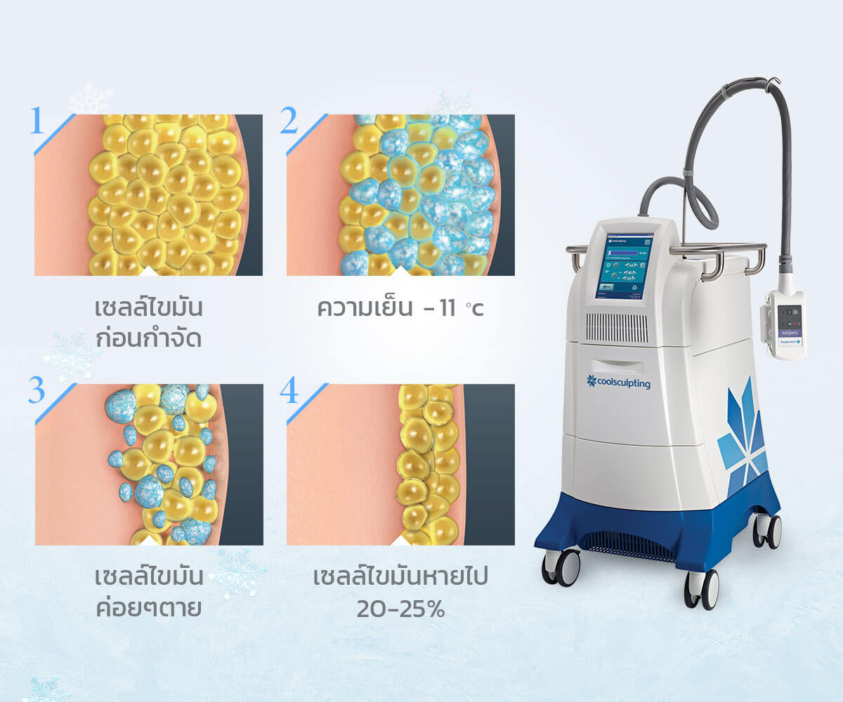 การทำงานของเครื่อง CoolSculpting