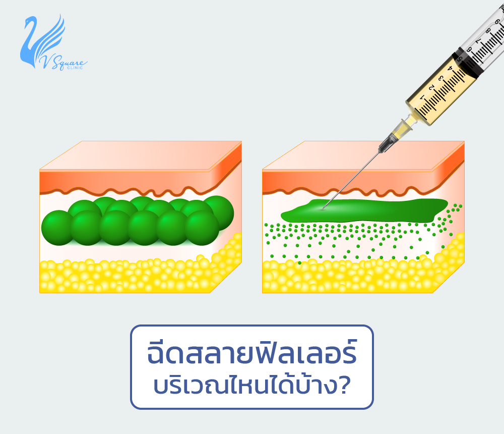 ฉีดสลายฟิลเลอร์