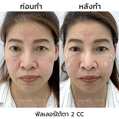 รีวิว before-after การฉีดฟิลเลอร์