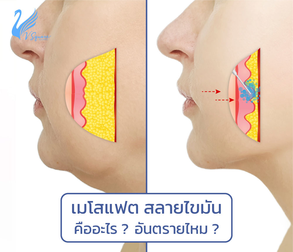 เมโสแฟต คืออะไร