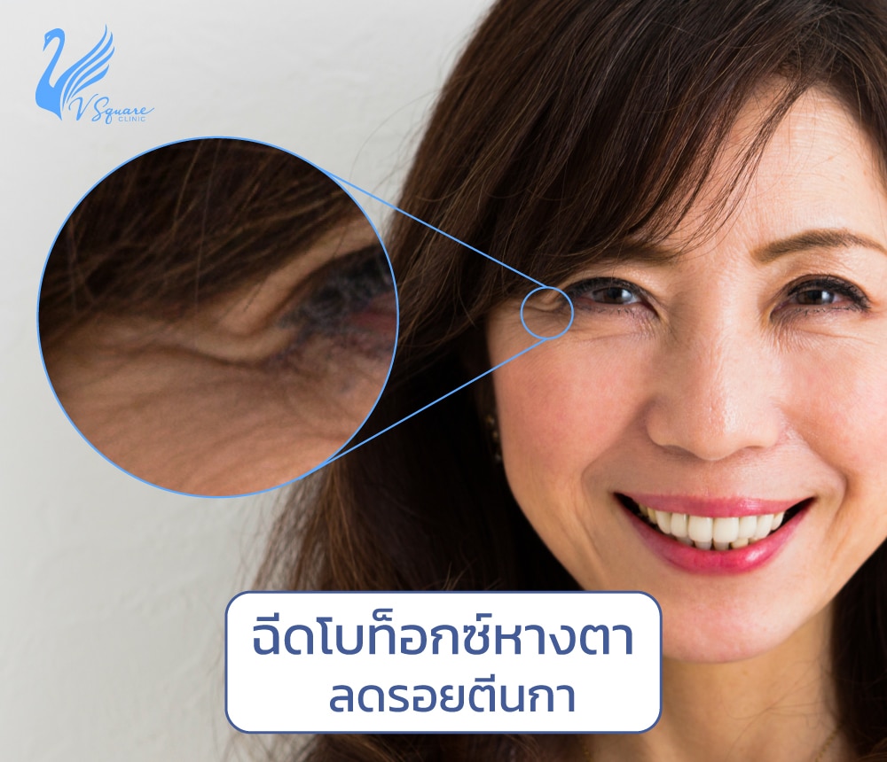 ฉีดโบท็อกซ์หางตา
