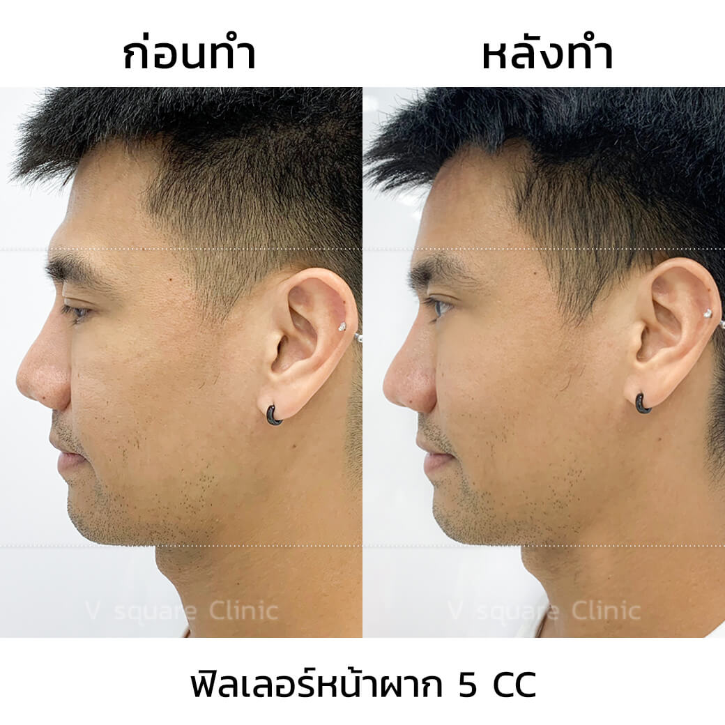 ตัวอย่างเคสรีวิวหลังฉีดฟิลเลอร์หน้าผาก พี่พีช