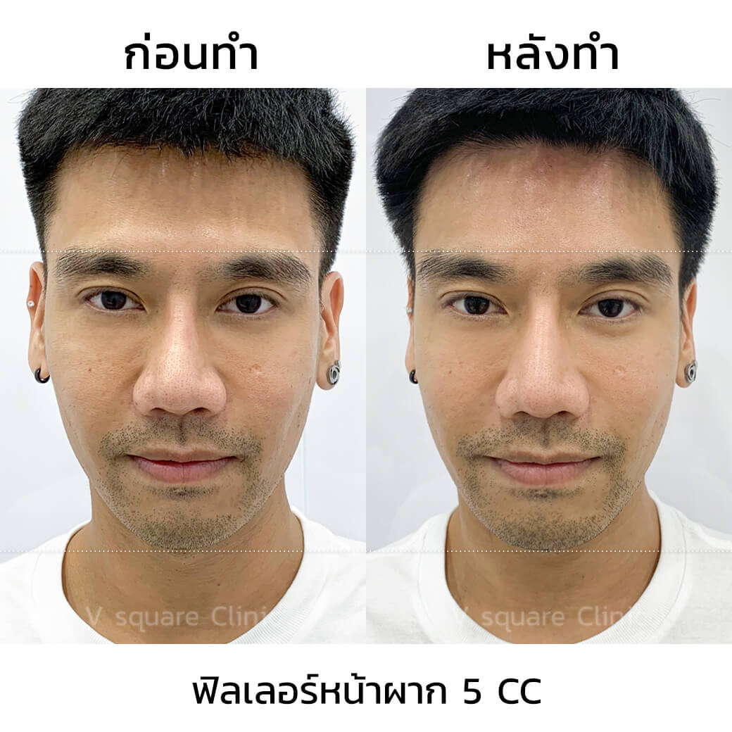 ตัวอย่างเคสรีวิวหลังฉีดฟิลเลอร์หน้าผาก-2 พี่พีช