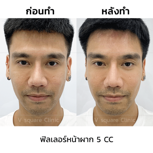 รีวิว-ฉีดฟิลเลอร์หน้าผาก
