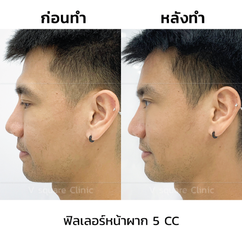 รีวิว-ฉีดฟิลเลอร์หน้าผาก