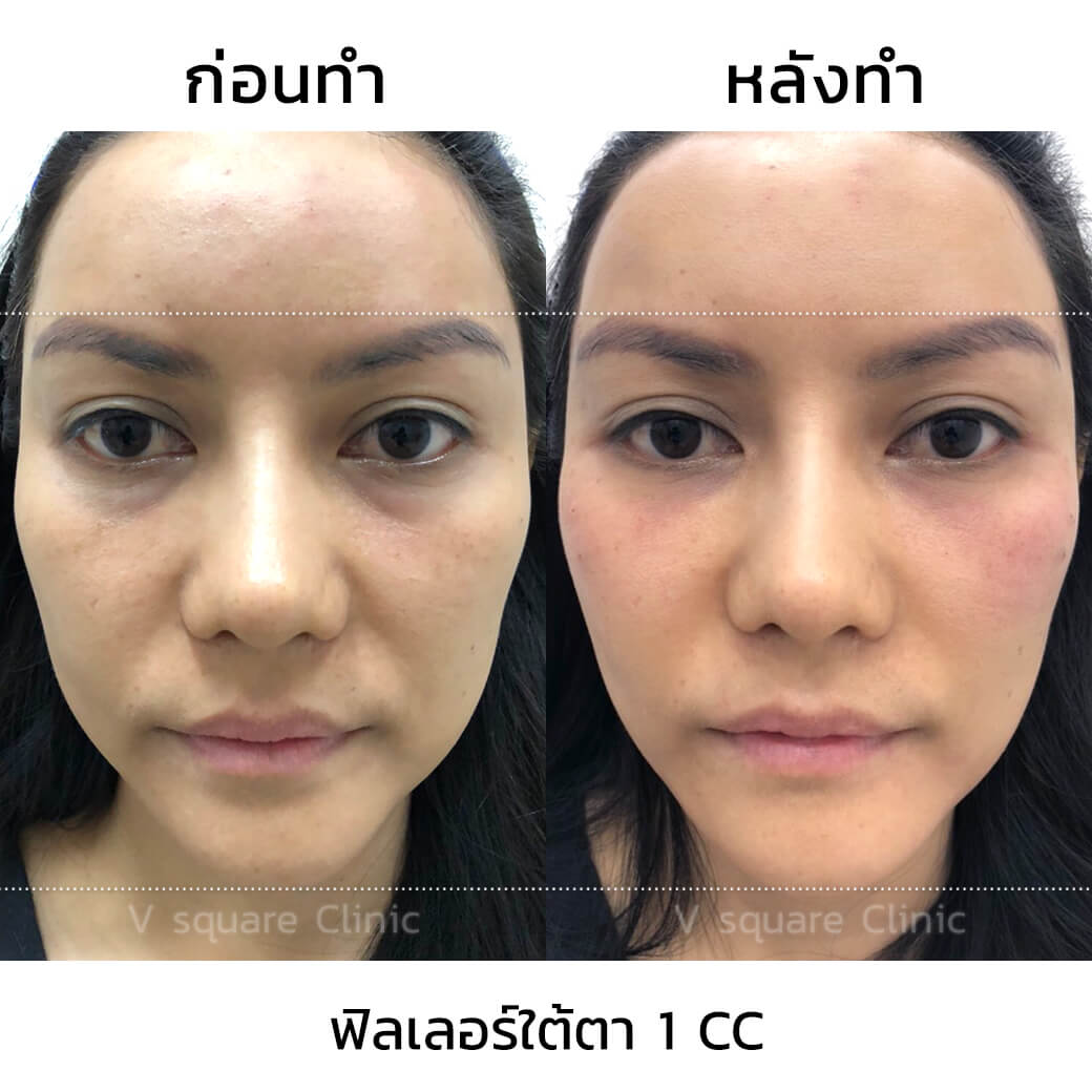 รีวิว-หลังฉีดฟิลเลอร์ใต้ตา