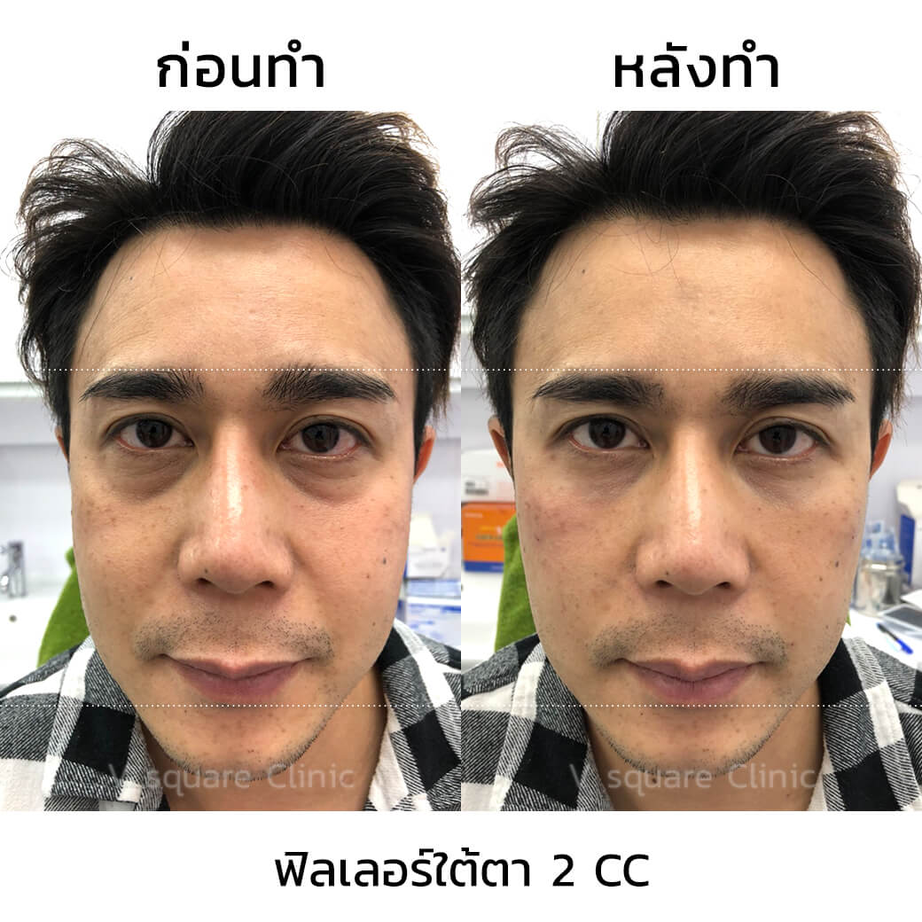 รีวิว-หลังฉีดฟิลเลอร์ใต้ตา