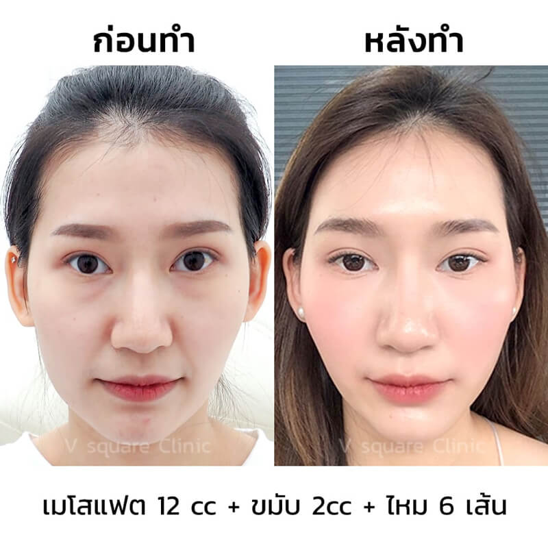 รีวิวฉีดฟิลเลอร์ขมับ