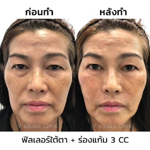 รีวิวฉีดฟิลเลอร์ร่องแก้มและฟิลเลอร์ใต้ตา