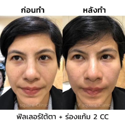 รีวิวฉีดฟิลเลอร์ร่องแก้มและฟิลเลอร์ใต้ตา
