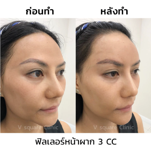 รีวิวฉีดฟิลเลอร์หน้าผาก