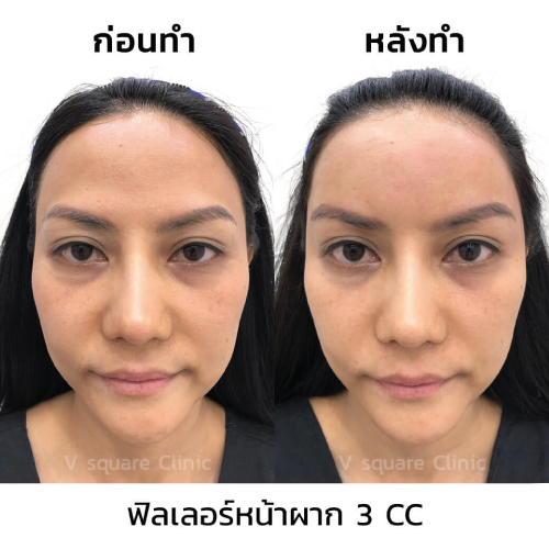 รีวิวฉีดฟิลเลอร์หน้าผาก