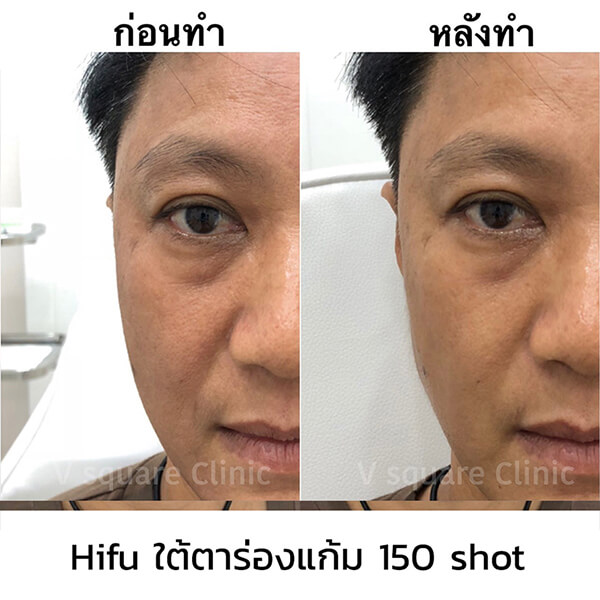 รีวิวทำ-Hifu