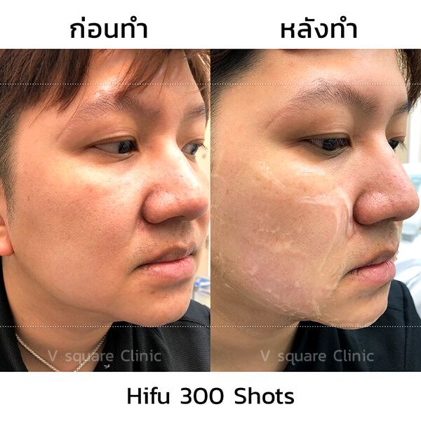 รีวิวทำ-Hifu