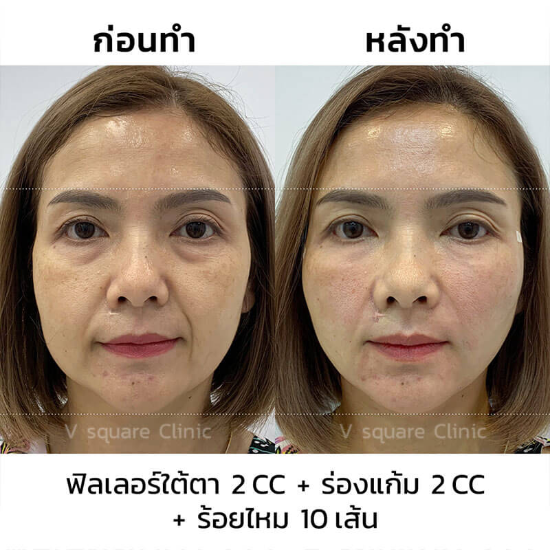 รีวิวร้อยไหมก้างปลา